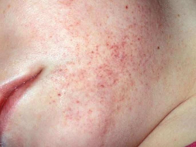 8 Common symptoms of Leukemia or blood cancer that slowly eat you up | ल्यूकेमियाकडे इशारा करतात ही ८ लक्षणे, दुर्लक्ष करणं ठरु शकतं जीवघेणं!