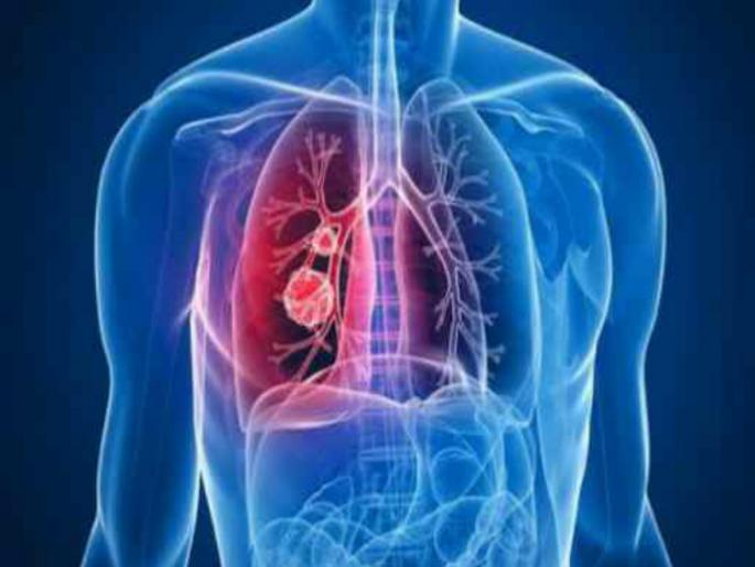 World Lung Cancer Day lung cancer can occur without smoking | World Lung Cancer Day: सिगारेट न ओढता देखील होऊ शकतो कर्करोग! जाणून घ्या मुख्य कारणे World Lung Cancer Day lung cancer can occur without smoking | World Lung Cancer Day: सिगारेट न ओढता देखील होऊ शकतो कर्करोग! जाणून घ्या मुख्य कारणे