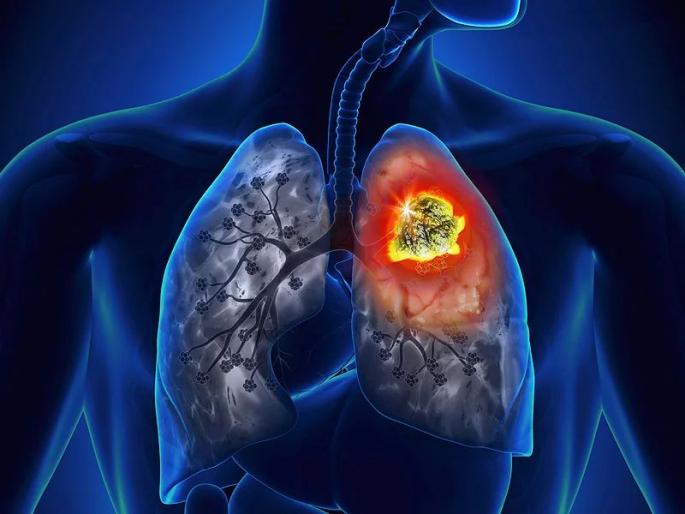 30 per cent of deaths due to lung cancer | फुप्फुस कर्करोगामुळे मृत्यूचे प्रमाण ३० टक्के; महिलांमध्ये २० टक्के प्रमाण