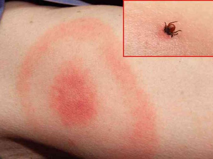 You should know about Lyme disease and its symptoms | केवळ १५ मिनिटात Lyme Disease चं होणार निदान, जाणून घ्या काय आहे हा आजार? You should know about Lyme disease and its symptoms | केवळ १५ मिनिटात Lyme Disease चं होणार निदान, जाणून घ्या काय आहे हा आजार?