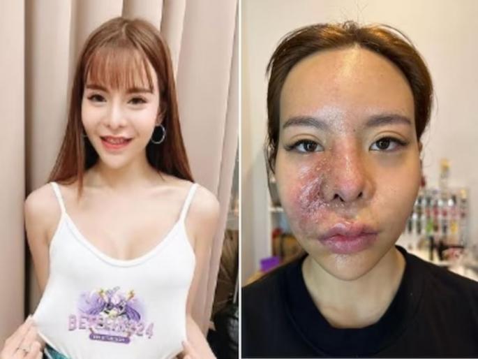 thailand model used cheap filler on face gets blisters pus due to reaction | पैसे वाचवण्यासाठी मॉडेलची स्वस्तात सर्जरी; झाली भयंकर अवस्था, आली चेहरा लपवण्याची वेळ thailand model used cheap filler on face gets blisters pus due to reaction | पैसे वाचवण्यासाठी मॉडेलची स्वस्तात सर्जरी; झाली भयंकर अवस्था, आली चेहरा लपवण्याची वेळ