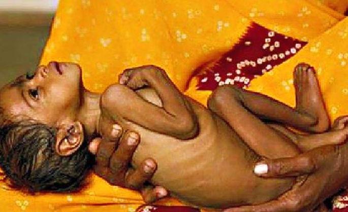 300 severely malnourished children found in Gondia district | धक्कादायक...! गाेंदिया जिल्ह्यात आढळली अतितीव्र कुपोषित ३०० बालके 300 severely malnourished children found in Gondia district | धक्कादायक...! गाेंदिया जिल्ह्यात आढळली अतितीव्र कुपोषित ३०० बालके
