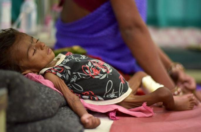 That said, there are no deaths due to malnutrition in Melghat; Health department's claim | म्हणे, मेळघाटात कुपोषणामुळे एकही मृत्यू नाही; आरोग्य विभागाचा जावईशोध That said, there are no deaths due to malnutrition in Melghat; Health department's claim | म्हणे, मेळघाटात कुपोषणामुळे एकही मृत्यू नाही; आरोग्य विभागाचा जावईशोध