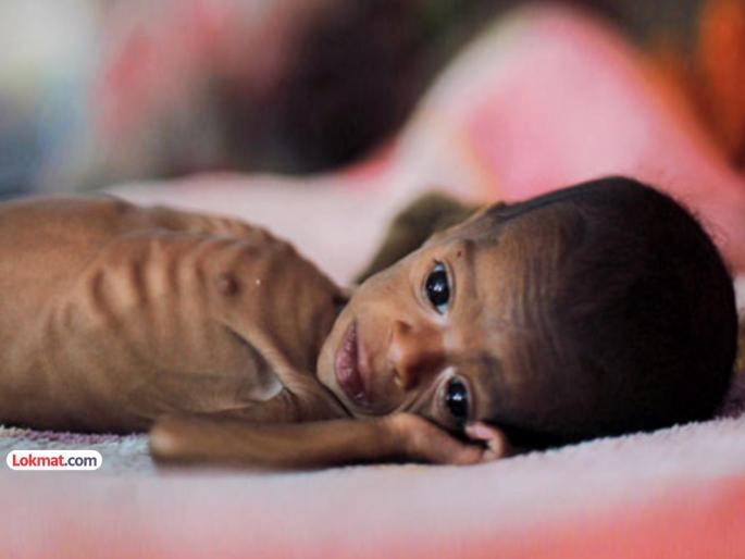 Malnutrition is decreasing in the state, but the risk remains! The challenge of accelerating child development schemes | राज्यातील कुपोषण घटतेय, पण धोका कायम! बालविकास योजनांना गती देण्याचे आव्हान Malnutrition is decreasing in the state, but the risk remains! The challenge of accelerating child development schemes | राज्यातील कुपोषण घटतेय, पण धोका कायम! बालविकास योजनांना गती देण्याचे आव्हान