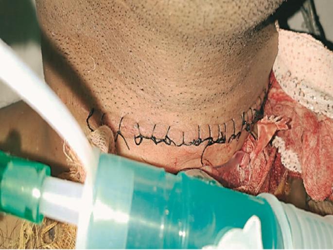 Shocking! Army Jawan's throat cut off due to Manja thread; Severe injury to the respiratory tract | धक्कादायक ! मांजाने कापला लष्करी जवानाचा गळा; थेट श्वसननलिकेपर्यंत झाली गंभीर जखम