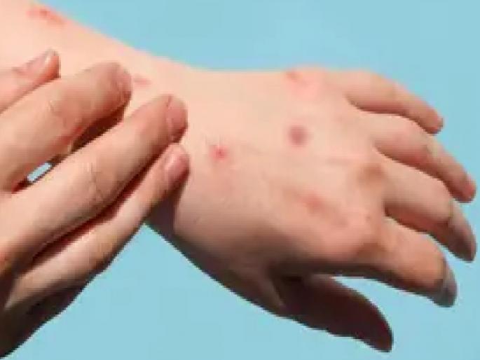 Implement protocols in the wake of monkeypox Congress leader Prithviraj Chavan's letter to the Chief Minister Eknath Shinde | ‘मंकीपॉक्स’ फैलावतोय, प्रोटोकॉल लागू करा; पृथ्वीराज चव्हाण यांचे मुख्यमंत्र्यांना पत्र Implement protocols in the wake of monkeypox Congress leader Prithviraj Chavan's letter to the Chief Minister Eknath Shinde | ‘मंकीपॉक्स’ फैलावतोय, प्रोटोकॉल लागू करा; पृथ्वीराज चव्हाण यांचे मुख्यमंत्र्यांना पत्र