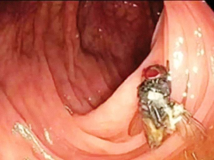 Jara Hatke : A live fly found in the stomach! Even enzymes, acids could not kill | पोटात सापडली जिवंत माशी! एन्झाइम्स, ॲसिडही मारू शकले नाहीत Jara Hatke : A live fly found in the stomach! Even enzymes, acids could not kill | पोटात सापडली जिवंत माशी! एन्झाइम्स, ॲसिडही मारू शकले नाहीत