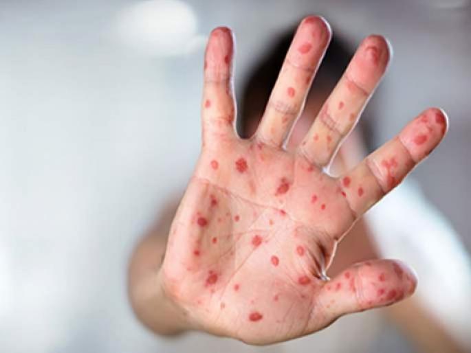 Two measles patients found in Nagpur; Health department on alert | नागपुरात गोवरचा शिरकाव, २ पॉझिटिव्ह रुग्ण आढळले; आरोग्य यंत्रणा सतर्क Two measles patients found in Nagpur; Health department on alert | नागपुरात गोवरचा शिरकाव, २ पॉझिटिव्ह रुग्ण आढळले; आरोग्य यंत्रणा सतर्क