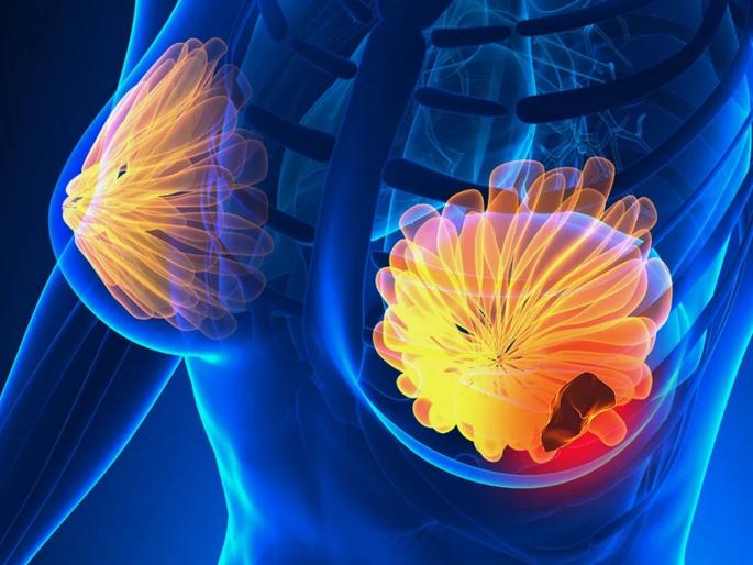 how to prevent breast cancer risk | ब्रेस्ट कॅन्सरचा धोका टाळण्यासाठी करा 'हे' उपाय how to prevent breast cancer risk | ब्रेस्ट कॅन्सरचा धोका टाळण्यासाठी करा 'हे' उपाय
