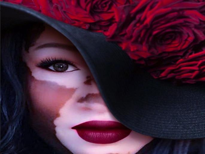 A rare skin condition model iomikoe johnson give positive message to society | तिनं बदलली सौंदर्याची व्याख्या; मॉडेलच्या फोटोंची जगभरात चर्चा A rare skin condition model iomikoe johnson give positive message to society | तिनं बदलली सौंदर्याची व्याख्या; मॉडेलच्या फोटोंची जगभरात चर्चा