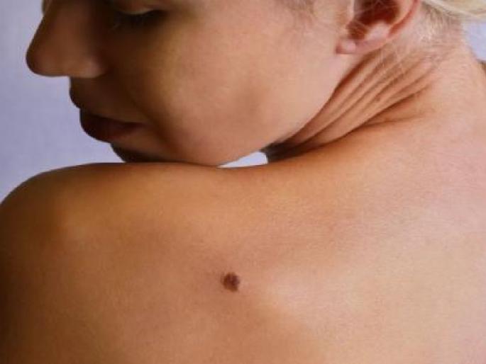 moles and freckles skin cancer | शरीरावरील 'या' खुणा आहेत कॅन्सरची लक्षणं, वेळीच ओळखा अन्यथा पडेल महागात moles and freckles skin cancer | शरीरावरील 'या' खुणा आहेत कॅन्सरची लक्षणं, वेळीच ओळखा अन्यथा पडेल महागात