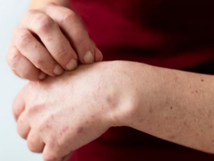 come from monkeypox affected countries Take care Guidelines issued by maharashtra State | Monkeypox Virus: मंकीपाॅक्सबाधित देशांतून आलात; ही घ्या काळजी! राज्याने जारी केल्या मार्गदर्शक सूचना come from monkeypox affected countries Take care Guidelines issued by maharashtra State | Monkeypox Virus: मंकीपाॅक्सबाधित देशांतून आलात; ही घ्या काळजी! राज्याने जारी केल्या मार्गदर्शक सूचना