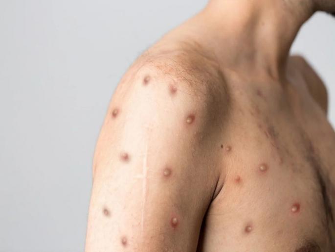 Fever, headache, body aches; No monkeypox symptoms right? | ताप, डोकेदुखी, अंगदुखी; मंकीपॉक्सची लक्षणे नाहीत ना? Fever, headache, body aches; No monkeypox symptoms right? | ताप, डोकेदुखी, अंगदुखी; मंकीपॉक्सची लक्षणे नाहीत ना?