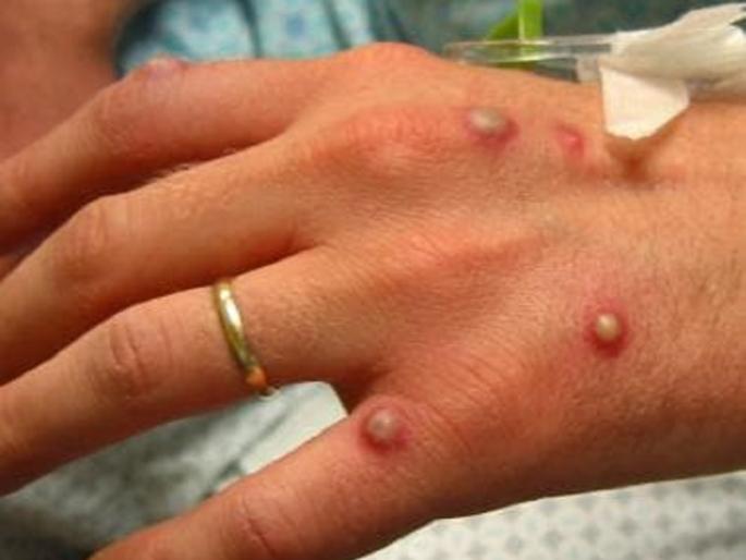 america monkeypox threat of new disease first case surfaced in america all you need to know | Monkeypox : अमेरिकेत आढळला 'मंकीपॉक्स'चा पहिला रुग्ण; काय आहे या आजाराची लक्षणे? जाणून घ्या, सविस्तर... america monkeypox threat of new disease first case surfaced in america all you need to know | Monkeypox : अमेरिकेत आढळला 'मंकीपॉक्स'चा पहिला रुग्ण; काय आहे या आजाराची लक्षणे? जाणून घ्या, सविस्तर...