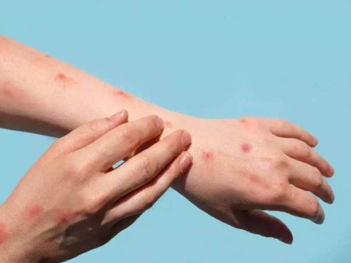 fever headache and body aches are symptoms of monkeypox know about the disease | ताप, डोकेदुखी, अंगदुखी; ‘मंकीपॉक्स’ची लक्षणे नाहीत ना? जाणून घ्या उपाय fever headache and body aches are symptoms of monkeypox know about the disease | ताप, डोकेदुखी, अंगदुखी; ‘मंकीपॉक्स’ची लक्षणे नाहीत ना? जाणून घ्या उपाय