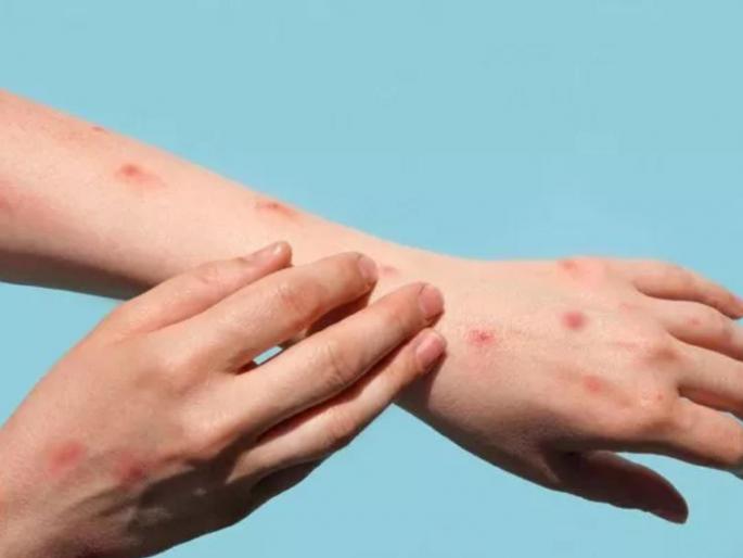 in mumbai dont be afraid of monkeypox says bmc 14 beds reserved in seven hills area checking at airport started | महापालिका म्हणते, ‘मंकीपॉक्स’ला घाबरू नका! ‘सेव्हन हिल्स’मध्ये १४ बेड राखीव, प्रशासन सतर्क