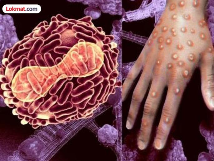 Monkeypox suspected patient found in India, what information was given by the Ministry of Health? | Monkeypox : भारतात आढळला मंकीपॉक्स संशयित रुग्ण, आरोग्य मंत्रालयाने काय दिली माहिती? Monkeypox suspected patient found in India, what information was given by the Ministry of Health? | Monkeypox : भारतात आढळला मंकीपॉक्स संशयित रुग्ण, आरोग्य मंत्रालयाने काय दिली माहिती?