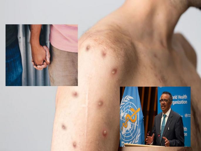 This sex-related mistake could make you a victim of monkeypox, WHO warns men | Monkeypox: सेक्सशी संबंधित ही चूक तुम्हाला बनवू शकते मंकीपॉक्सची शिकार, WHOचा पुरुषांना इशारा  This sex-related mistake could make you a victim of monkeypox, WHO warns men | Monkeypox: सेक्सशी संबंधित ही चूक तुम्हाला बनवू शकते मंकीपॉक्सची शिकार, WHOचा पुरुषांना इशारा