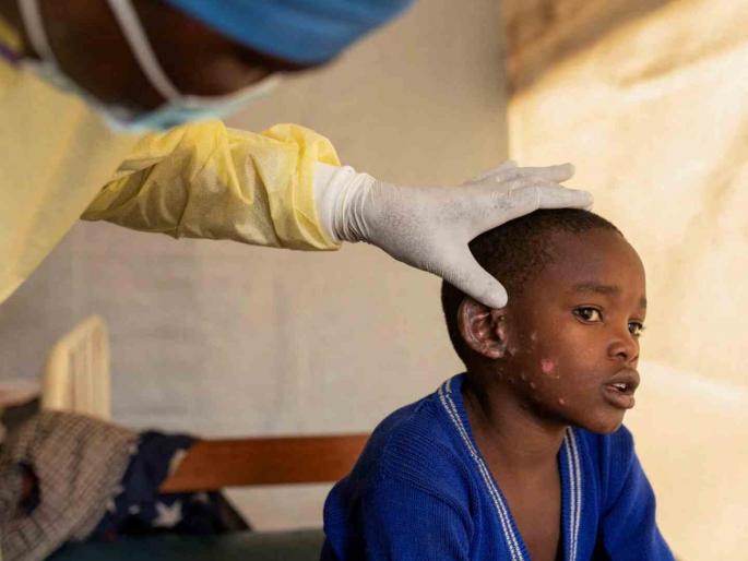 Monkeypox reaches Pakistan, fear of rising cases Alert on hospitals-airports in India | काळजी घ्या! मंकीपॉक्स पाकिस्तानात पोहोचला, वाढत्या केसेसची भीती; भारतातील रुग्णालये-विमानतळांवर अलर्ट Monkeypox reaches Pakistan, fear of rising cases Alert on hospitals-airports in India | काळजी घ्या! मंकीपॉक्स पाकिस्तानात पोहोचला, वाढत्या केसेसची भीती; भारतातील रुग्णालये-विमानतळांवर अलर्ट