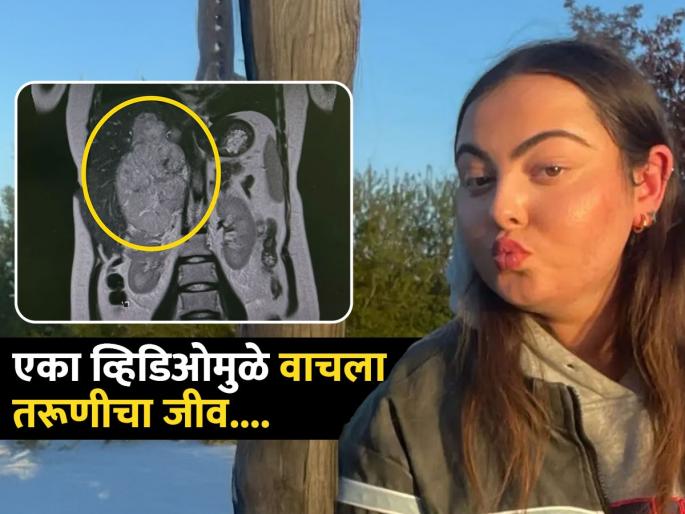 Girl blamed morning coffee for moon face but adrenal cortical cancer was the real reason | चेहरा सूजला, गोल झाला...तिला वाटलं कॉफीमुळे झालं असेल, पण पोटात लपून होता जीवघेणा आजार