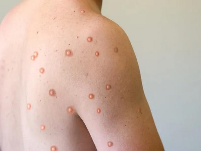 Mpox is a Global threat Entry of new virus after Corona; Children most at risk, 400 deaths so far | कोरोनानंतर आता नवीन व्हायरसची एन्ट्री; लहान मुलांना सर्वाधिक धोका, आतापर्यंत 400 मृत्यू Mpox is a Global threat Entry of new virus after Corona; Children most at risk, 400 deaths so far | कोरोनानंतर आता नवीन व्हायरसची एन्ट्री; लहान मुलांना सर्वाधिक धोका, आतापर्यंत 400 मृत्यू