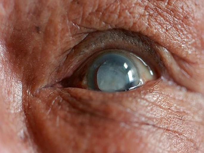 Natural vision now even after cataracts; A dream come true... | मोतीबिंदूनंतरही आता नैसर्गिक दृष्टी; स्वप्नवत गोष्ट प्रत्यक्षात... Natural vision now even after cataracts; A dream come true... | मोतीबिंदूनंतरही आता नैसर्गिक दृष्टी; स्वप्नवत गोष्ट प्रत्यक्षात...