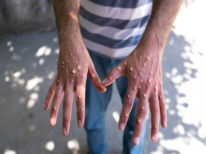 The first case of monkeypox has been detected in the country, the central government has officially informed | देशात मंकीपॉक्सचा पहिला रुग्ण आढळला, केंद्र सरकारनं अधिकृतपणे दिली माहिती The first case of monkeypox has been detected in the country, the central government has officially informed | देशात मंकीपॉक्सचा पहिला रुग्ण आढळला, केंद्र सरकारनं अधिकृतपणे दिली माहिती