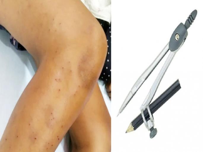 indore-students-torched-with-a-compass-in-school | चौथीत शिकणाऱ्या मुलांमध्ये भांडण, तिघांनी मिळून एकाला कंपासने 108 वेळा भोसकले indore-students-torched-with-a-compass-in-school | चौथीत शिकणाऱ्या मुलांमध्ये भांडण, तिघांनी मिळून एकाला कंपासने 108 वेळा भोसकले