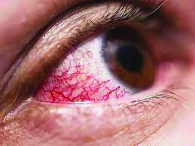 Patients wandering for the treatment of Mucormycosis infarction | म्युकरमायकाेसीसच्या रुग्णांची उपचारासाठी हाेतेय भटकंती Patients wandering for the treatment of Mucormycosis infarction | म्युकरमायकाेसीसच्या रुग्णांची उपचारासाठी हाेतेय भटकंती