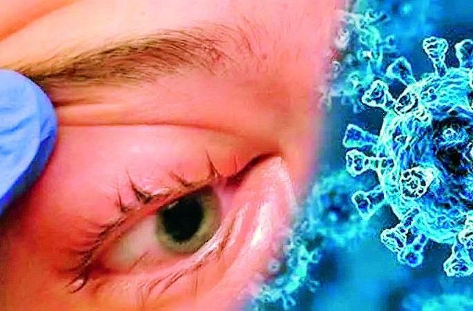 In Amravati division, treatment is started on 104 patients with mucomycosis | अमरावती विभागात म्युकरमायकोसिसच्या १०४ रुग्णांवर उपचार सुरू