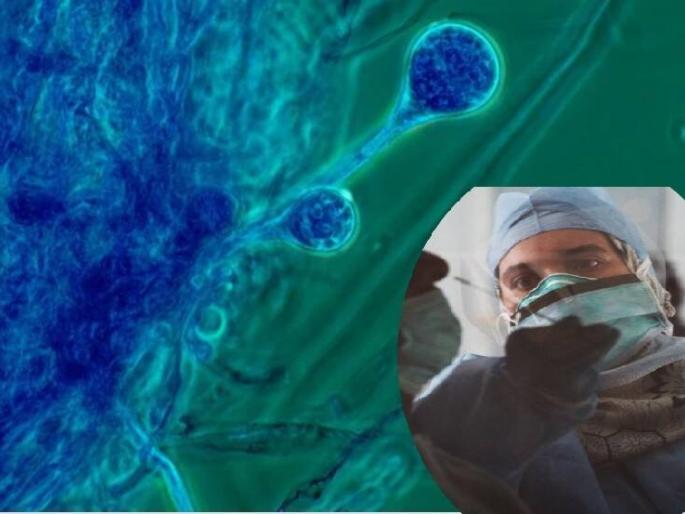 The curable disease of myocardial infarction; Know the symptoms and preventive measures | म्युकरमायकोसिस बरा होणारा आजार; जाणून घ्या लक्षणे अन् प्रतिबंधात्मक उपाय