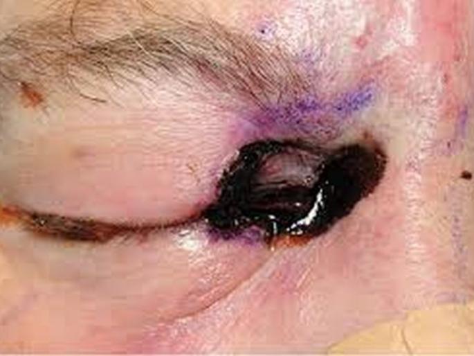 Mucormycosis patients from Gujarat, Madhya Pradesh in Akola for treatment! | गुजरात, मध्यप्रदेशातील म्युकरमायकोसिसचे रुग्ण उपचारासाठी अकोल्यात!