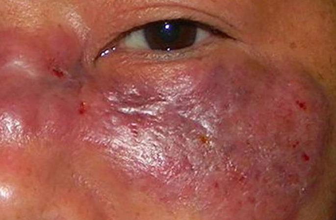 Crisis of Mucormycosis infarction in patients after corona | कोरोनानंतर रुग्णांवर म्युकरमायकोसिसचे संकट