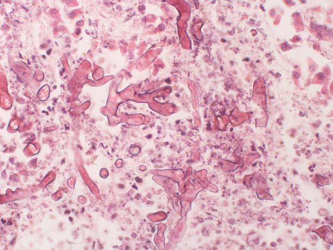 Succeeding in saving the life of a woman suffering from ‘mucormycosis’ |  ‘म्यूकोर्मिकोसिस’ने ग्रस्त महिलेचे प्राण वाचवण्यात यश, कोरोनाचीही होती लागण Succeeding in saving the life of a woman suffering from ‘mucormycosis’ |  ‘म्यूकोर्मिकोसिस’ने ग्रस्त महिलेचे प्राण वाचवण्यात यश, कोरोनाचीही होती लागण