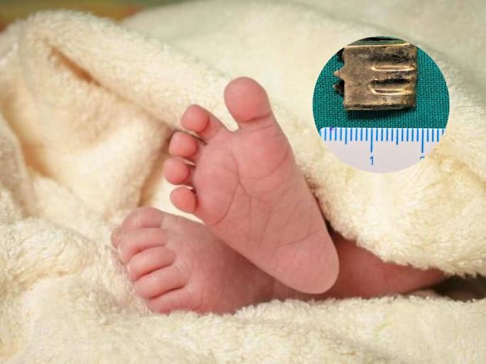 Mumbai: Wadia Hospital Doctors Successfully Save 10-Month-Old Boy After Sharp Zipper Stopper Stuck In Food Pipe For 2 Weeks | Mumbai: वाडिया रुग्णालयाला मोठं यश, झिपर स्टॉपर गिळलेल्या १० महिन्याच्या बाळाला वाचवलं!