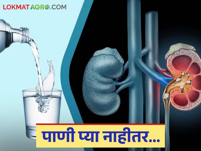 Mutkhada : Why does the risk of kidney stones increase in summer? Find out in detail | Mutkhada : उन्हाळ्यात किडनी स्टोन मुतखड्याचा धोका का वाढतो? जाणून घ्या सविस्तर Mutkhada : Why does the risk of kidney stones increase in summer? Find out in detail | Mutkhada : उन्हाळ्यात किडनी स्टोन मुतखड्याचा धोका का वाढतो? जाणून घ्या सविस्तर