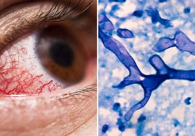 Mucormycosis: Mucormycosis is now a pain in the abdomen! | Mucormycosis: म्युकरमायकोसिस झालं आता पोटदुखीच्या अॅटॅकचं दुखणं! Mucormycosis: Mucormycosis is now a pain in the abdomen! | Mucormycosis: म्युकरमायकोसिस झालं आता पोटदुखीच्या अॅटॅकचं दुखणं!