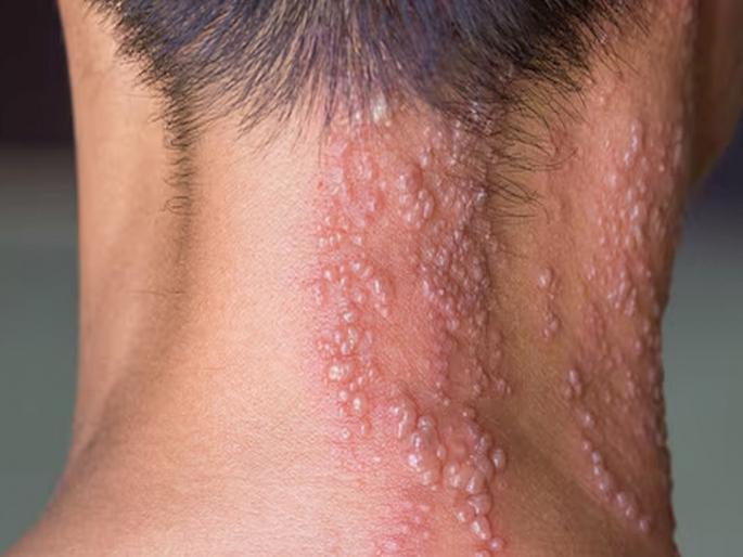 Shingles symptoms in Marathi: Beware! 'Naagin' can be fatal after 50 years; 75 million adults in India are at risk of serious diseases | सावधान! वयाच्या पन्नाशीनंतर 'नागीण' ठरू शकते जीवघेणी; ४८% भारतीय डॉक्टरांचा सल्लाही घेत नाहीत Shingles symptoms in Marathi: Beware! 'Naagin' can be fatal after 50 years; 75 million adults in India are at risk of serious diseases | सावधान! वयाच्या पन्नाशीनंतर 'नागीण' ठरू शकते जीवघेणी; ४८% भारतीय डॉक्टरांचा सल्लाही घेत नाहीत
