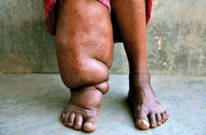 Four thousand patients of elephantiasis in Nagpur district | नागपूर जिल्ह्यात हत्तीपायाचे चार हजारांवर रुग्ण