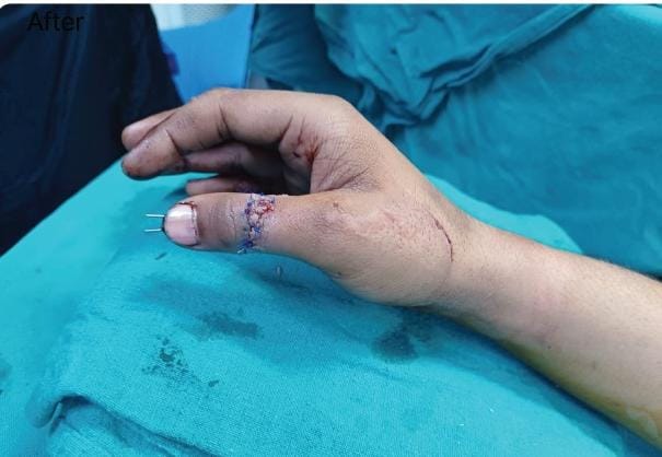 The thumb got caught in the chain of the bike and broke | बाईकच्या चेनमध्ये हाताचा अंगठा अडकून तुटला