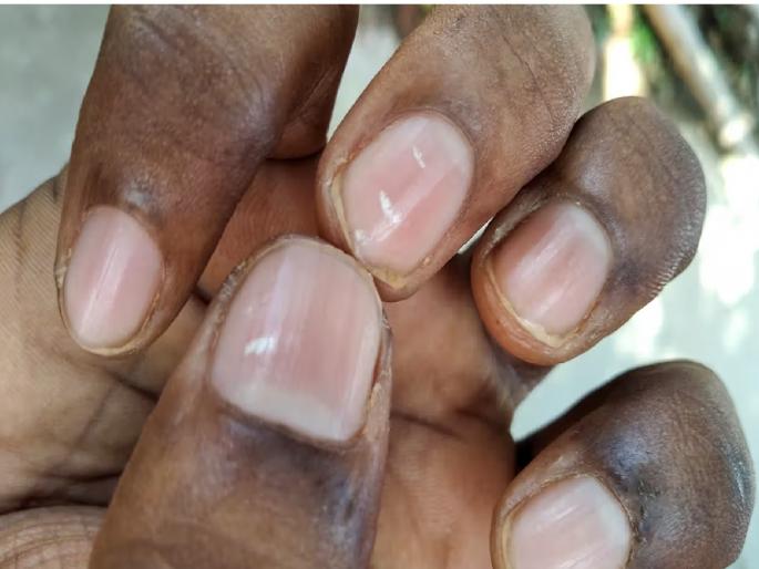 White spots on nails, crooked nails; do you know the reasons? | नखांवर पांढरे डाग, वेडीवाकडी नखं; कारणं माहीत आहेत का? आरोग्य समस्यांचे देतात संकेत? White spots on nails, crooked nails; do you know the reasons? | नखांवर पांढरे डाग, वेडीवाकडी नखं; कारणं माहीत आहेत का? आरोग्य समस्यांचे देतात संकेत?