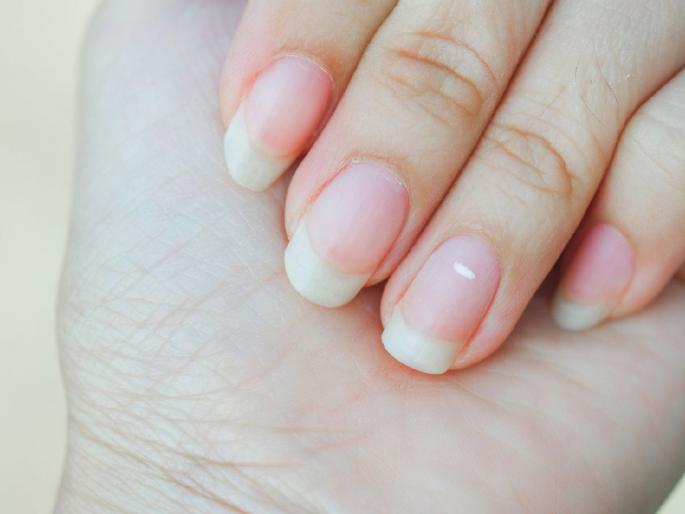 why-do-white-spots-appear-on-nails | नखांवर पांढरे डाग का येतात ? जाणून घ्या... why-do-white-spots-appear-on-nails | नखांवर पांढरे डाग का येतात ? जाणून घ्या...