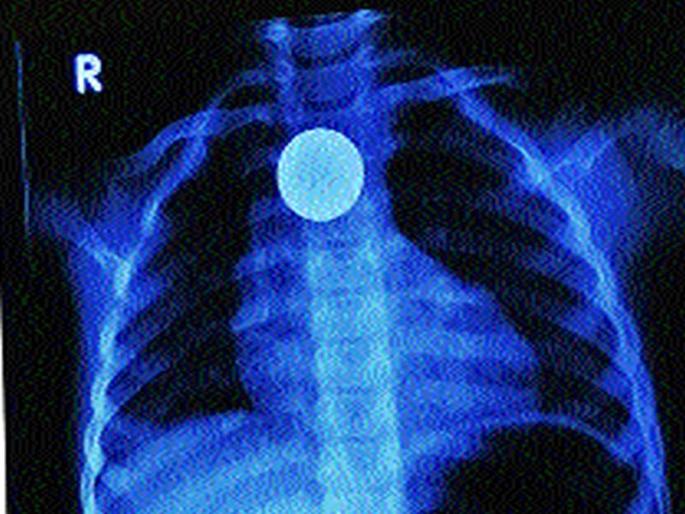 Doctor success to take out a five-year-old coin with endoscopy | तीन वर्षांच्या मुलीने गिळलेले पाच रुपयांचे नाणे एन्डोस्कोपीद्वारे बाहेर काढण्यात डॉक्टरांना यश Doctor success to take out a five-year-old coin with endoscopy | तीन वर्षांच्या मुलीने गिळलेले पाच रुपयांचे नाणे एन्डोस्कोपीद्वारे बाहेर काढण्यात डॉक्टरांना यश