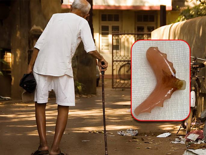 83 year old senior citizen swallowed sheaf doctor succeeded in removing by surgery | ८३ वर्षांच्या ज्येष्ठ नागरिकाने गिळली होती कवळी, डॉक्टरांकडून 'ऑपरेशन' यशस्वी 83 year old senior citizen swallowed sheaf doctor succeeded in removing by surgery | ८३ वर्षांच्या ज्येष्ठ नागरिकाने गिळली होती कवळी, डॉक्टरांकडून 'ऑपरेशन' यशस्वी