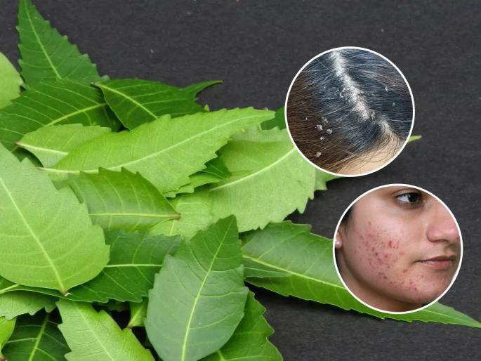 Benefits of neem leaves for health how to use neem for pimples neem remedy for dandruff natural cure for acne and boils | आरोग्यासाठी वरदान आहे कडुनिंबाची पानं! 'असा' करा उपयोग, पुटकुळ्या-फोड्या- कोंडा होईल दूर