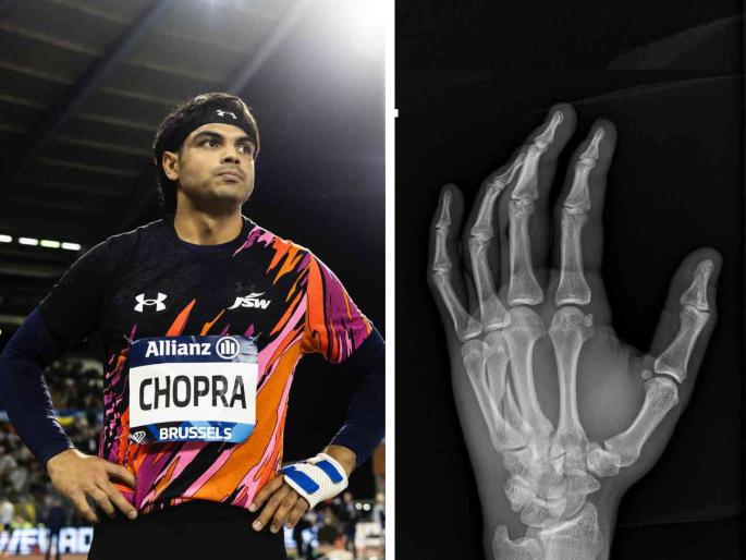 Neeraj Chopra undergoes surgery in Switzerland after diamond league 2024 final javelin throw injury health update viral video | 'गोल्डन बॉय' नीरज चोप्रावरील शस्त्रक्रिया यशस्वी; दुखापतग्रस्त हाताने खेळलेला 'डायमंड लीग' Neeraj Chopra undergoes surgery in Switzerland after diamond league 2024 final javelin throw injury health update viral video | 'गोल्डन बॉय' नीरज चोप्रावरील शस्त्रक्रिया यशस्वी; दुखापतग्रस्त हाताने खेळलेला 'डायमंड लीग'