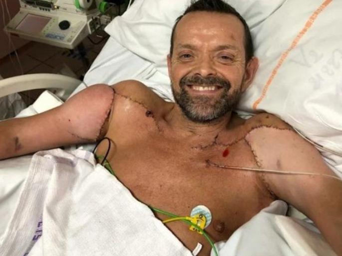 first time hand transplant surgery in the world, Ireland arm transplant case | अविश्वसनीय! जगात पहिल्यांदाच मिळाले एका व्यक्तीला नवे हात, तब्बल २३ वर्षांनी प्रयत्न झाला यशस्वी first time hand transplant surgery in the world, Ireland arm transplant case | अविश्वसनीय! जगात पहिल्यांदाच मिळाले एका व्यक्तीला नवे हात, तब्बल २३ वर्षांनी प्रयत्न झाला यशस्वी