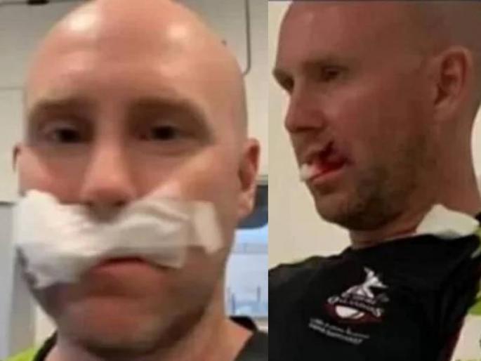 ben dunck hit by ball in catching practice gets 7 stiches onlips | पाकिस्तान सुपर लीगमध्ये भयानक घटना, खेळाडूच्या तोंडावर आदळला चेंडू, ७ टाके अन् सर्जरी!