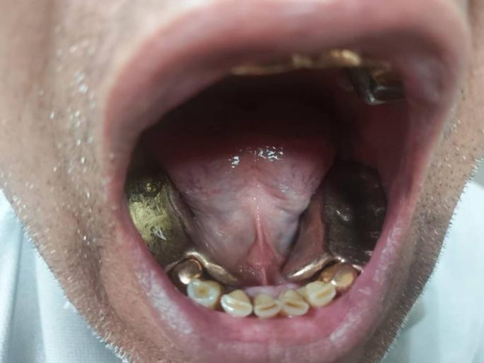 951 grams gold smuggled as dentures seized at Delhi Airport | अधिकाऱ्यांनी दोघांना विमानतळावर रोखले, तोंड उघडण्यास सांगितले; पाहून सारेच चक्रावले 951 grams gold smuggled as dentures seized at Delhi Airport | अधिकाऱ्यांनी दोघांना विमानतळावर रोखले, तोंड उघडण्यास सांगितले; पाहून सारेच चक्रावले