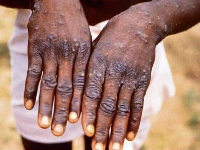 Monkey Pox Thane Municipal Corporation warns health department What are the symptoms Read here | 'मंकी पॉक्स'ची दहशत, ठाणे महापालिकेने आरोग्य विभागाला दिला सतर्कतेचा इशारा; काय आहे लक्षणं वाचा... Monkey Pox Thane Municipal Corporation warns health department What are the symptoms Read here | 'मंकी पॉक्स'ची दहशत, ठाणे महापालिकेने आरोग्य विभागाला दिला सतर्कतेचा इशारा; काय आहे लक्षणं वाचा...